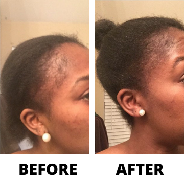 Three Bottles of Rennora EXTRA-Strength Hair Growth Serum